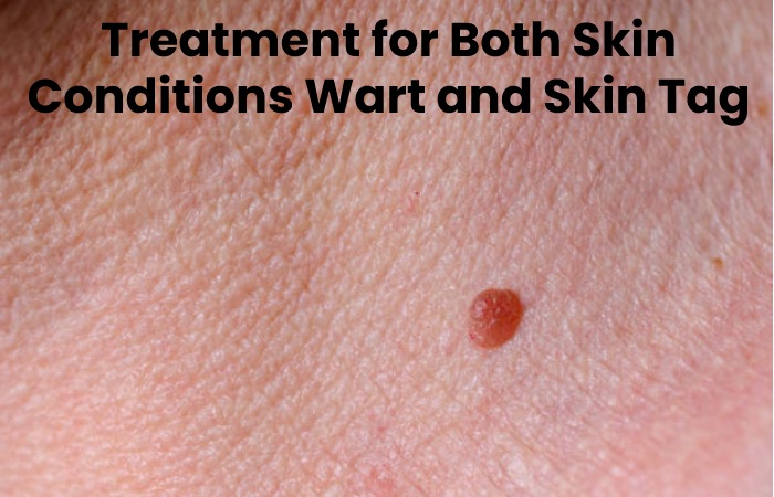 Treatment for Both Skin Conditions Wart and Skin Tag