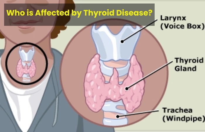 Who is Affected by Thyroid Disease?
