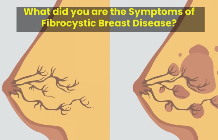 What did you are the Symptoms of Fibrocystic Breast Disease?
