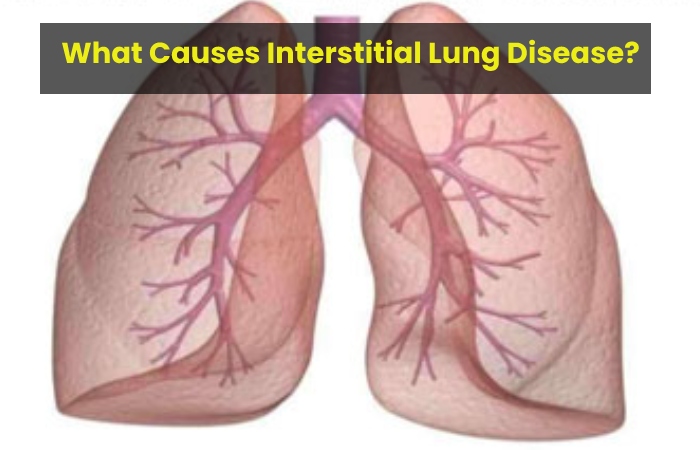 What Causes Interstitial Lung Disease?