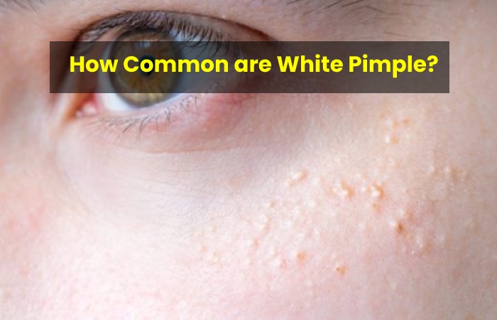 How Common are White Pimple?