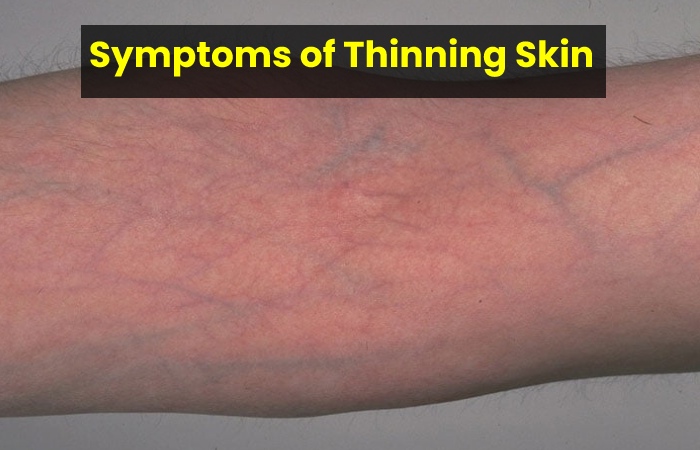 Symptoms of Thinning Skin