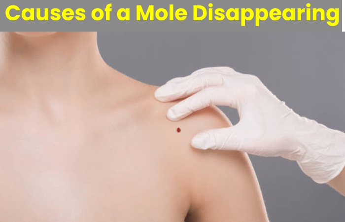 causes of a mole disappearing