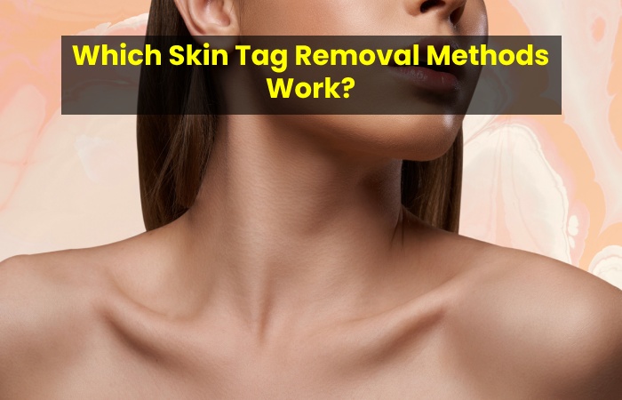 Which Skin Tag Removal Methods Work?