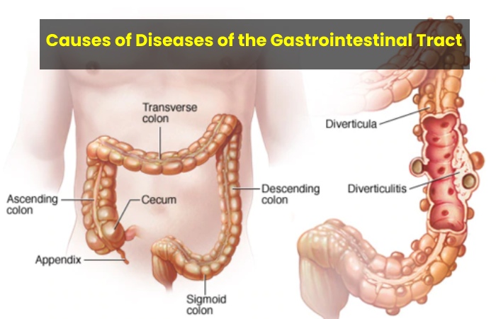 Causes of Diseases of the Gastrointestinal Tract